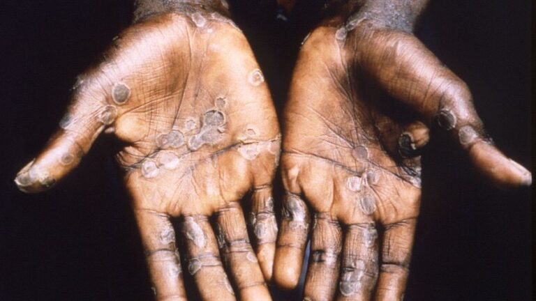 How Has Monkeypox Spread All Over the Globe at Lightning Speed?